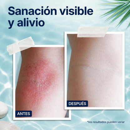 The Ocean Healed | Tratamiento Tópico Especializado para Piel Atópica. Fórmula Suave y Efectiva que Calma el Eczema y Restaura el Confort